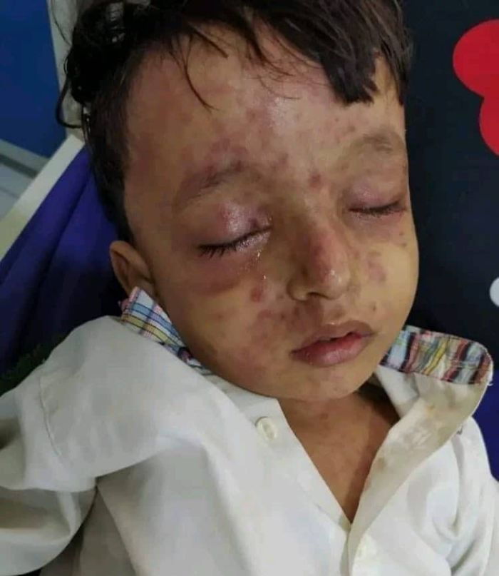 تداعيات استمرار رفض مليشيا الحوثي تطعيم الأطفال بأمصال الحصْبة ( تقرير)