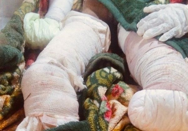 شبكة حقوقية: تسجيل 3 آلاف و607 حالات قتل وإصابة بألغام مليشيا الحوثي
