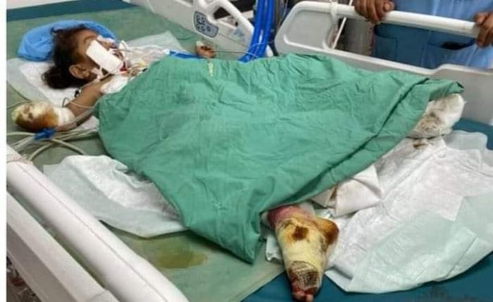 إصابة امراة وطفلين من أسرة واحدة بانفجار لغم حوثي غرب تعز